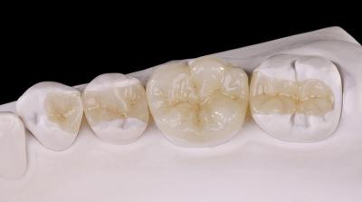 중국 반투명 지르코니아 치아 인레이 자연 구멍 모양을 회복하기 위해 온레이 왕관 판매용