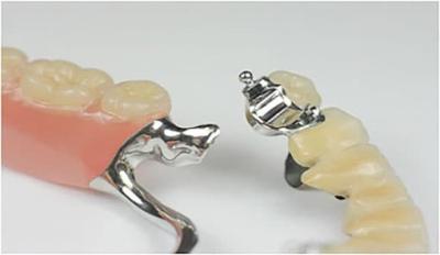 China Apego de precisión extraíble Dentadura parcial Profesional estable en venta