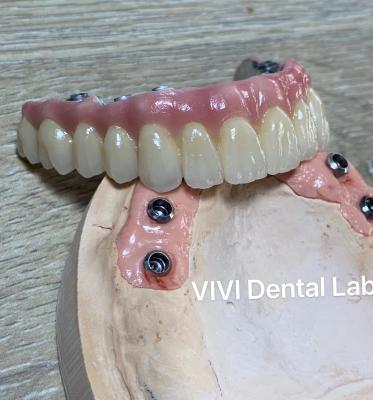 China Coronilla de implante dental de alta estética / coronilla retenida por tornillo ISO aprobada en venta