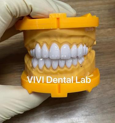 China Ivoclar Emax Laminate Veneers High Translucency China Dental Lab for sale