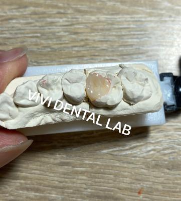 China VIVI Inlay Dental Compuesto Onlay Alta Estética Certificado ISO en venta
