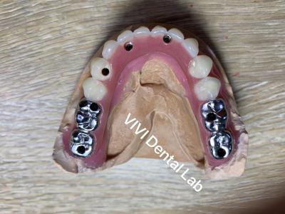 China Screwed Implant Supported Dentures High Accuracy FDA ISO Certificated for sale