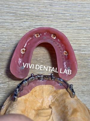 China Dental Bar Implant Assisted Dentures High Esthetics Good Fit with attachments for sale