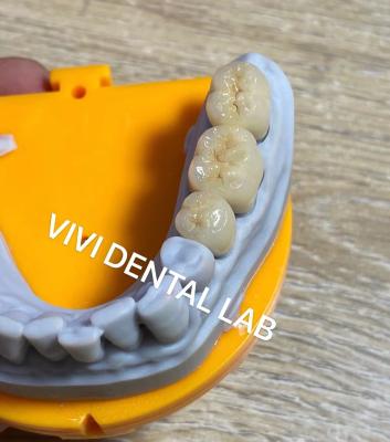China Coronas Dentárias Digitais de Alta Precisão Modelo Impresso Noritake Porcelana à venda