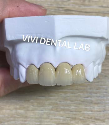 China PFM Coronas dentales de laboratorio Técnica SLM con polvo de aleación Scheftner 30 en venta