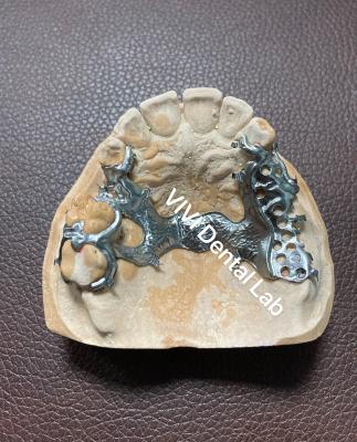 China Lightweight Titanium Partial Dentures Exocad 3shape Digital Dentures for sale