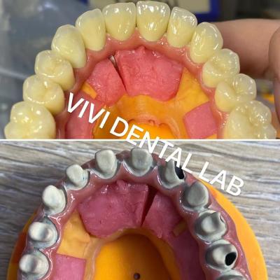 China Proceso de las coronas dentales digitales Ivoclar Noritake Porcelana de alta precisión en venta