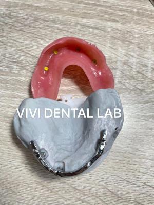 China Ivoclar Digital Dental Implant Bar Denture With Attachments for sale