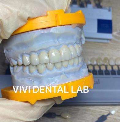Κίνα Υψηλό Translucency Incisal καπλαμάδων Emax αισθητικών δοντιών φυλλόμορφο οδοντικό εργαστήριο της Κίνας προς πώληση