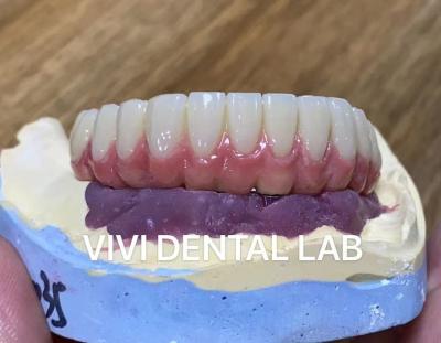 China Composite Veneered Tooth Supported Bridge Implant Ivoclar Customized for sale