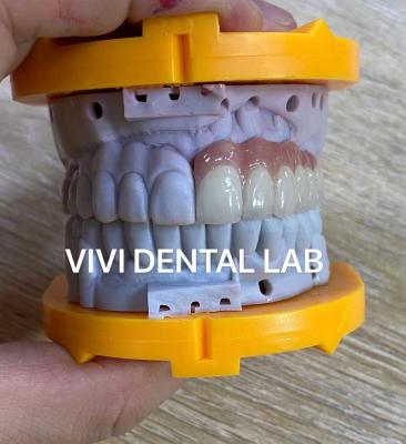China Ivoclar PFM digitale tandheelkundige kronen brug symmetrisch met roze porselein Te koop
