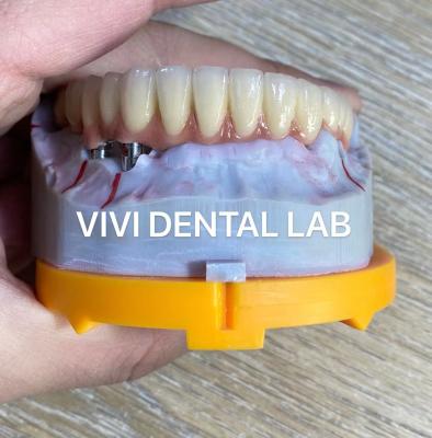 China Alloy Dental Implant Supported Crowns Implants And Bridges Digital for sale