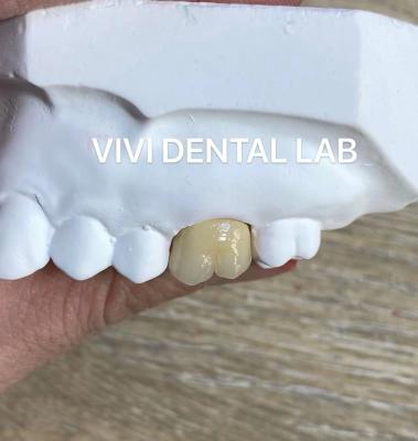 China Coronas de porcelana de metal Be Ni Precise Estética PFM Coronas dentales en venta