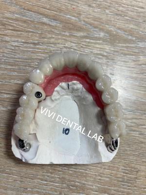 China Cement Teeth Implant Dental Bridge PFM Screwed Metal Porcelain for sale