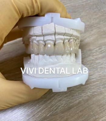 China Coroas de laboratório dentário de precisão Estética de porcelana Coroa dentária de zircônia à venda