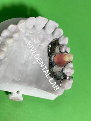 China Unilateral Framework Metal Partial Denture Alloy 3 Shape Exocad Perfect Fit for sale