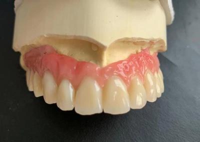 Китай Телескопический имплантат короны поддерживаемые зубные протезы Ivoclar Scheftner на титановых подошвах продается
