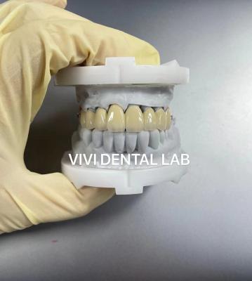 China Scheftner Ivoclar Combinación de dentadura parcial de metal puente dental PFM en venta