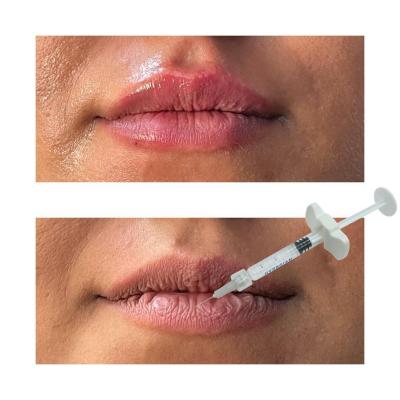 China Non Surgical Lip Enhancement Fillers Hyaluronic Acid Lip Injections for sale