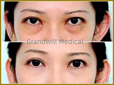 China Enchimentos cutâneos faciais ácidos hialurónicos para o círculo de enchimento do olho da calha do rasgo à venda