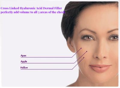 中国 注射可能なナトリウムのHyaluronateの皮膚注入口のMidfaceの容積の損失の処置のふくよかな頬 販売のため