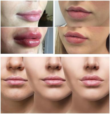 China Smooth Lines / Plump Lips With Hyaluronic Acid Injectable Filler 1ml 2ml 5ml for sale