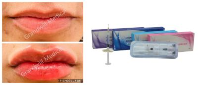 China Cross Linked Sodium Hyaluronic Acid Injection Dermal Filler For Lip Fullness Facial Wrinkles for sale