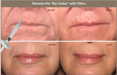 中国 10ml Injectable Hyaluronic Acid Dermal Filler For Correcting Facial Asymmetry 販売のため