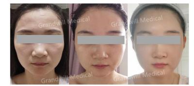Cina Stimolatore acido ialuronico del collagene della pelle di ritocco di miracolo del ripetitore della pelle di PCL in vendita