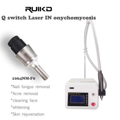 China Nd Yag Laser In Onychomycosis Nail Fungus Laser Nail Fungi With 1064nm-F0 for sale