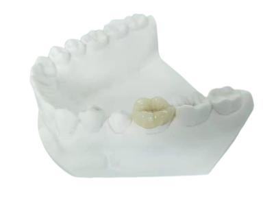 Chine Onlay dentaire Tout-en céramique durable de marqueterie de placage de couronne de FDA semblable à vendre