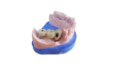 China CAD CAM Zirconia Dental Crown With Titanium Base Zirconia Abutment for sale