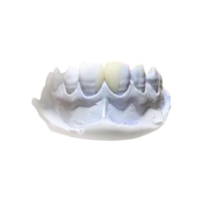 China Materiais dentais removíveis da saúde da coroa da resina eficiente PFM à venda