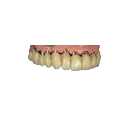 China La corona telescópica 3D dental del puente de la corona del implante de la leva PFM del cad imprimió modelos en venta