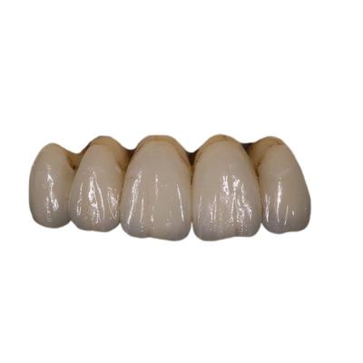 China Easy Maintain Orthodontic PFM Porcelain Dental Crown Colour Stability for sale