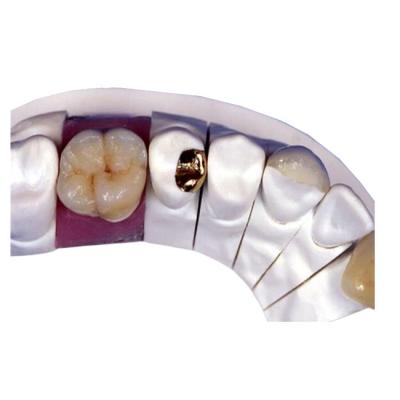 China PFM Porcelain Dental Crown for sale