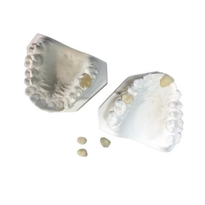 China Easy Maintain OEM White Ceramic Dental Crown Veneer Inlay Onlay for sale