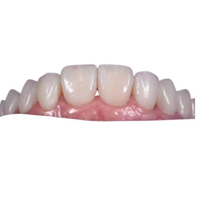China Coroa dental cerâmica clareando de 0.3MM para substituir os dentes insalubres à venda