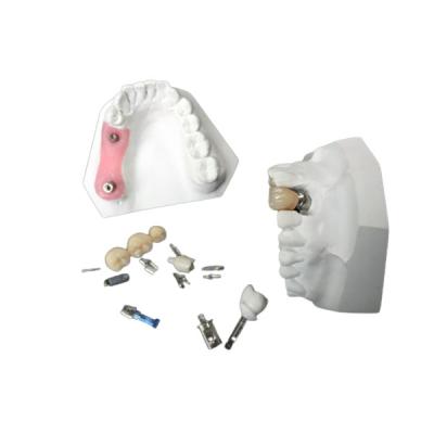 China Alta corona del implante dental de la circona de la durabilidad para la restauración dental en venta