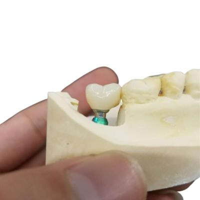 Chine Couleur ultra dur l'OEM de stabilité la couronne d'implant que dentaire facile maintiennent à vendre