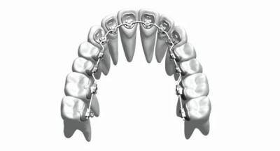 Chine Les accolades orthodontiques fixes d'appareils de coutume redressent l'acier inoxydable Bioceramic de dents à vendre