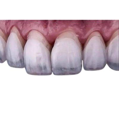 Chine Placages fortifiants de couronne de zircone de laboratoire de dentiers dentaires dentaires de placages à vendre