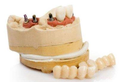 China Kundengebundener Zahnimplantat-Ersatz-dauerhafter Titanzahnimplantat zu verkaufen