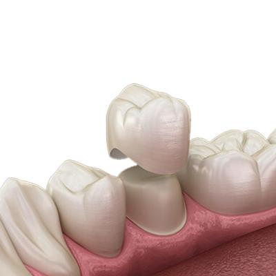 China OEM Natural Zirconia Dental Crown Unique Crack Resistant Tough Curing for sale