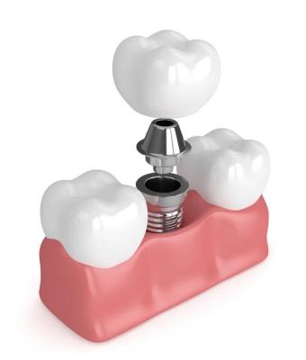 China True Dentures Implants Single All Ceramic Dentures Missing Teeth Fillings for sale
