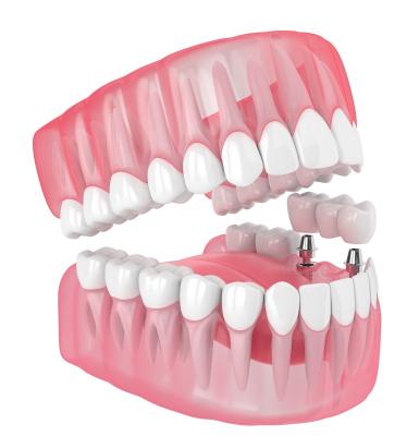 China Single All Ceramic Teeth Dental Implants Missing Filling Dentures Wisdom Teeth for sale