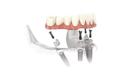 China Invisible Removable Dentures Filled Implants Complete Restoration Overdenture for sale