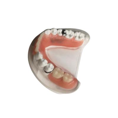 China Prótesis dental de zirconia Garantía de calidad de la corona Prótesis removibles por encargo en venta