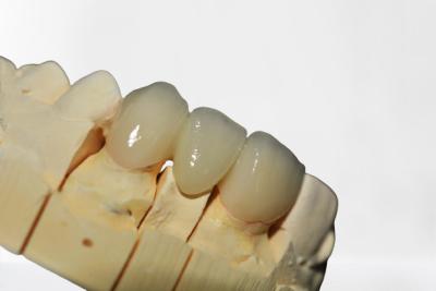 中国 よい安定性の歯科王冠橋きれいな、整頓された良質のきれいおよび整頓された 販売のため