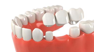 Китай OEM Dental Crown Bridge Good Biocompatibility Smooth Surface Make Smile Sweeter продается